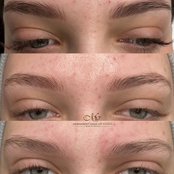 Лазерне видалення за 2 процедури -чиста шкіра