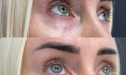 Заполнение носослезки Косметолог-ін'єкціоніст Любов Запоріжжя