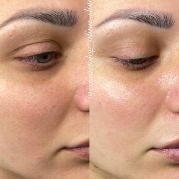 Чистка обличчя ПУРІТІ з ОЗОНОТЕРАПІЄЮ