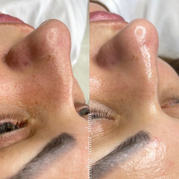 Чистка обличчя Пуріті на косметиці з ОЗОНОМ ,Озонотерапія