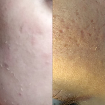 Микронидлинг
                    Мастер перманентного макияжа  Харьков