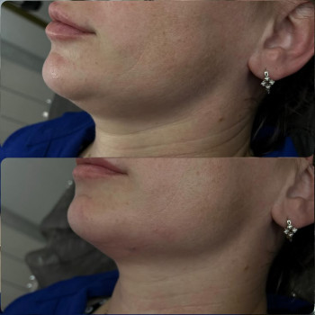 Контурна пластика обличчя, Кути Джолі підборіддя 2 ml Neuramis Volume