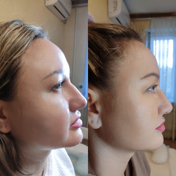 Результати після 2 процедур ліполітику Smart 4 Derma 10 ml