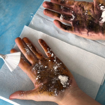 лікування гіпергідрозу