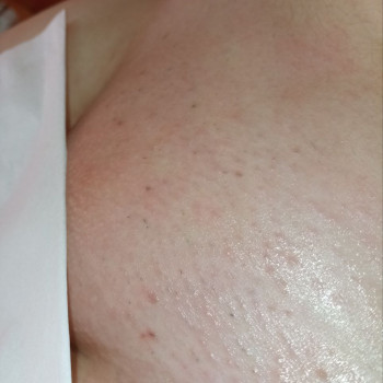 Шугаринг бікіні