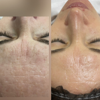 Екзосоми
                    Косметолог-естетист Зинаида Ужгород