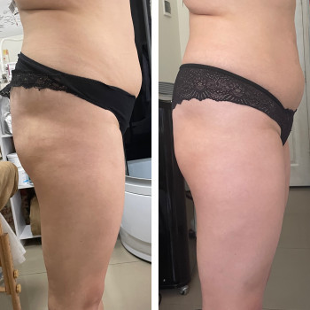 Пресотерапія
                    Косметолог-эстетист Зинаида Ужгород