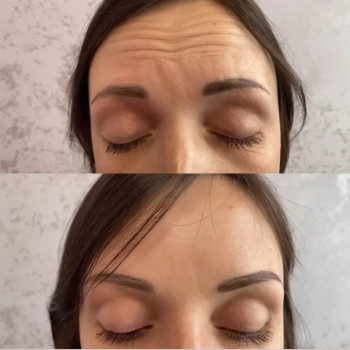 Ботулінотерапія обличчя
                    Косметолог-ін'єкціоніст Максим Полтава