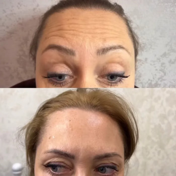 Ботулінотерапія обличчя
                    Косметолог-ін'єкціоніст Максим Полтава