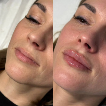 Контурна пластика губ
                    Косметолог-инъекционист Максим Полтава