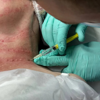 Мезотерапия
                    Косметолог-ін'єкціоніст Максим Полтава