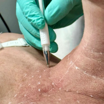 Мезотерапия
                    Косметолог-ін'єкціоніст Максим Полтава