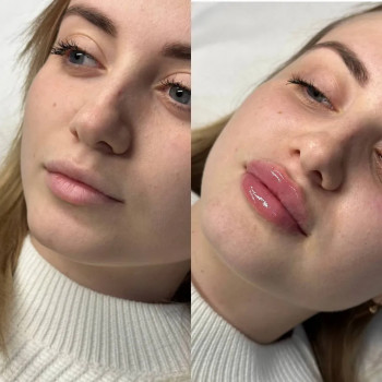 Збільшення губ 
 #збільшеннягуб #конутрнапластикагуб
 #аугментаціягуб
 #губи