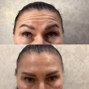 Ботулінотерапія зони лоба та міжбрів'я
 
 
 
 