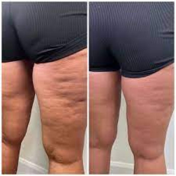 Антицелюлітний масаж ніг
                    Масажист Наталія Рівне