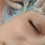 Біоревіталізація шкіри обличчя Масажист Мария Київ