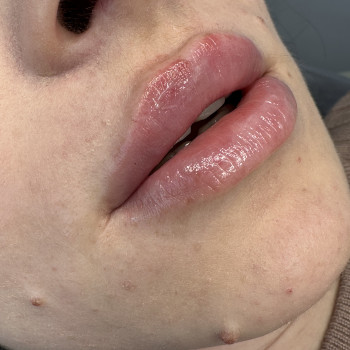 Збільшення губ