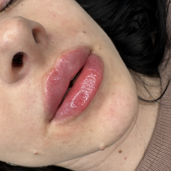 Збільшення губ