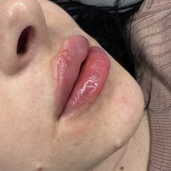 Збільшення губ