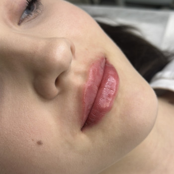 Натуральне збільшення губ