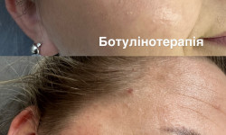 Ботулінотерапія Косметолог Уляна Львів