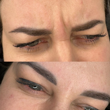 Ботулінотерапія
                    Косметолог Уляна Львів