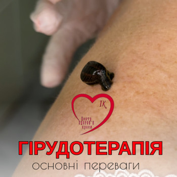 Гірудотерапія    #