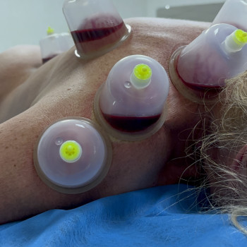 Хіджама — це процедура для виведення застійної крові.
                    Массажист Юлия Черноморск