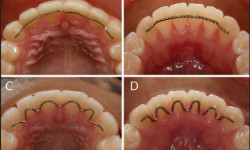 Ретейнеры Стоматологічна клініка Пальміра Дент Полтава
