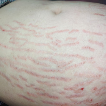 Микронидлинг(удаление растяжек)
                    Салон красоты NM beauty studio Днепр