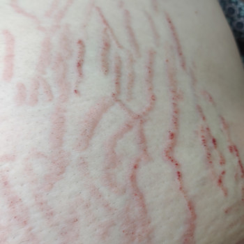 Микронидлинг(удаление растяжек)
                    Салон красоты NM beauty studio Днепр