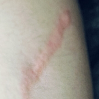 Микронидлинг(удаление растяжек)
                    Салон красоты NM beauty studio Днепр