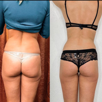 Антицеллюлитный масаж
                    Массажист Филипп Днепр