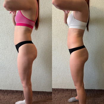 Антицеллюлитный масаж
                    Массажист Филипп Днепр