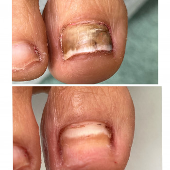 Подология
                    Мастер маникюра Наталья Кременчуг