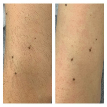 Депіляція ніг