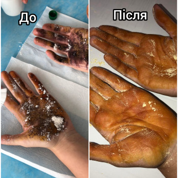 Гипергідроз,  ботоксом  