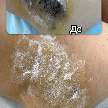 Гипергидроз 