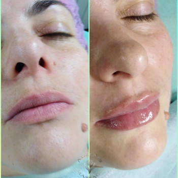 Аугментація губ філером
                    Масажист Юлія Київ