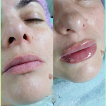 Аугментація губ філером
                    Масажист Юлія Київ