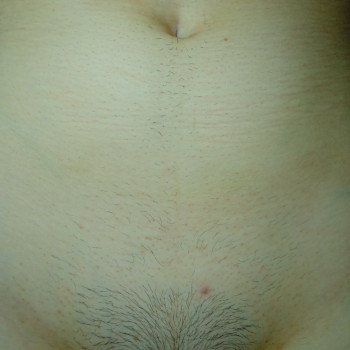 Зона бікіні