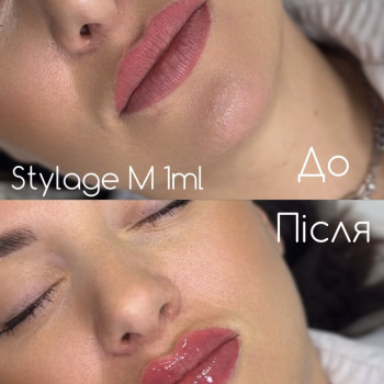 Збільшення губ