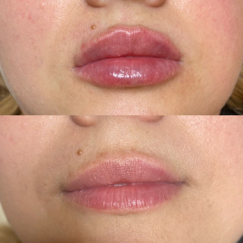   пластика губ