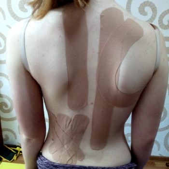 Кінезіотейпування при сколіозі