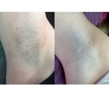 Лазерна епіляцію, зона пахви, 4 процедури, до/після