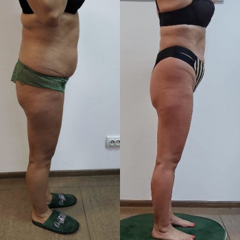 Ендосфера курс 10 процедур+2 термообгорання, до /після