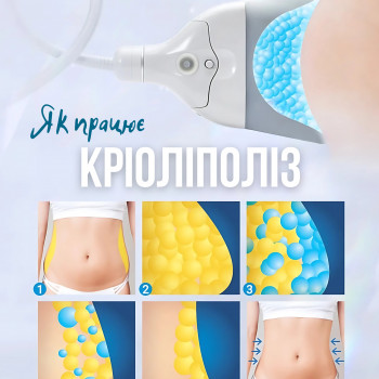 Кріоліполіз