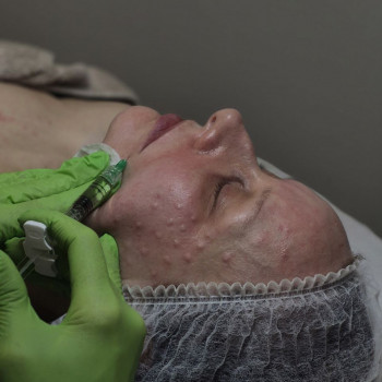 Мезотерапія обличчя та шия