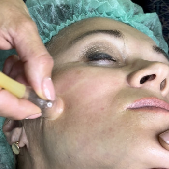 Вакуумний масаж для підтягнення контуру обличчя