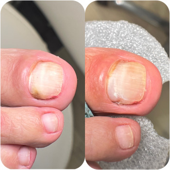 Травма нігтя у вузькому взутті